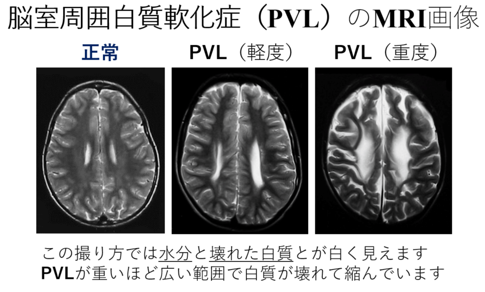 脳性まひの診断 社会医療法人大道会 ボバース記念病院