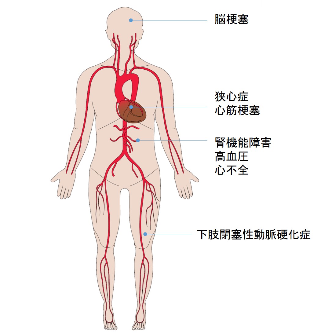 動脈 症 硬化 性 閉塞