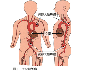 心臓 破裂 と は